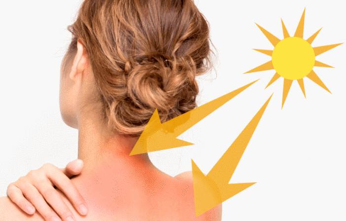 Allergie au Soleil : Comment Soigner Boutons, Plaques, Rougeurs dus à l ...